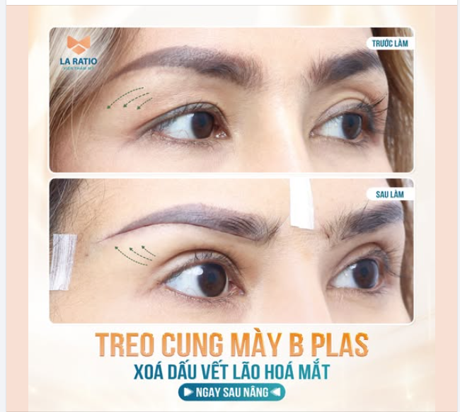 TRẺ HÓA MẮT TOÀN DIỆN SAU 7 NGÀY NÂNG CUNG MÀY