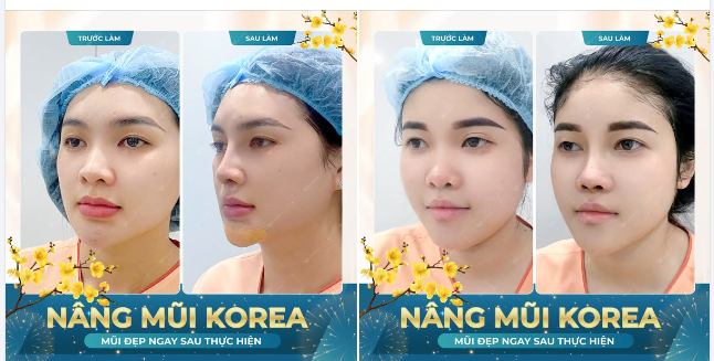 Nâng mũi cấu trúc Korea - Tôn tạo dáng mũi đẹp chuẩn Hàn