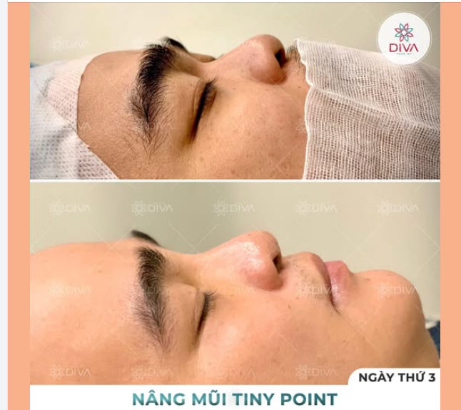MŨI BỊ GÃY TRŨNG SÂU NGANG MẮT: PHƯƠNG PHÁP NÀO CẢI THIỆN TỐT NHẤT?