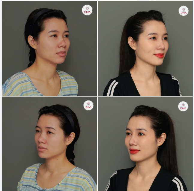 CẢI THIỆN DÁNG MŨI THẤP - TRŨNG GÃY, GỒ SỐNG MŨI MỘT CÁCH TỰ NHIÊN, HÀI HÒA VỚI PP NÂNG MŨI TINY POINT