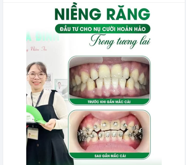 NIỀNG RĂNG - ĐẦU TƯ CHO NỤ CƯỜI HOÀN HẢO TRONG TƯƠNG LAI