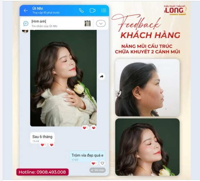 NÂNG MŨI XONG MỚI HIỂU: ĐẸP LÀ QUYỀN LỢI, TỰ TIN LÀ HẠNH PHÚC!