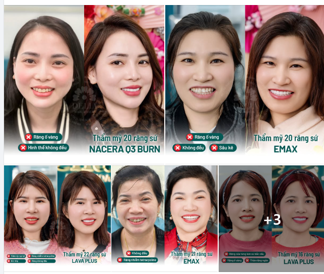 THẨM MỸ RĂNG SỨ KIẾN TẠO NỤ CƯỜI HOÀN MỸ