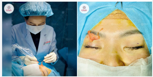 TẠM BIỆT MỠ THỪA MÍ MẮT CHỈ SAU 10 - 15 PHÚT!