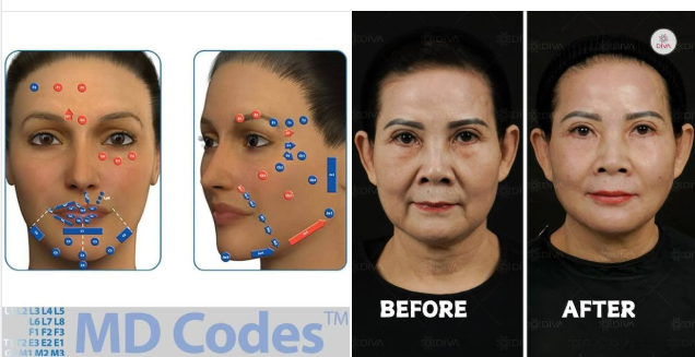 FILLER MD CODES CÓ SƯNG BẦM NHIỀU KHÔNG?