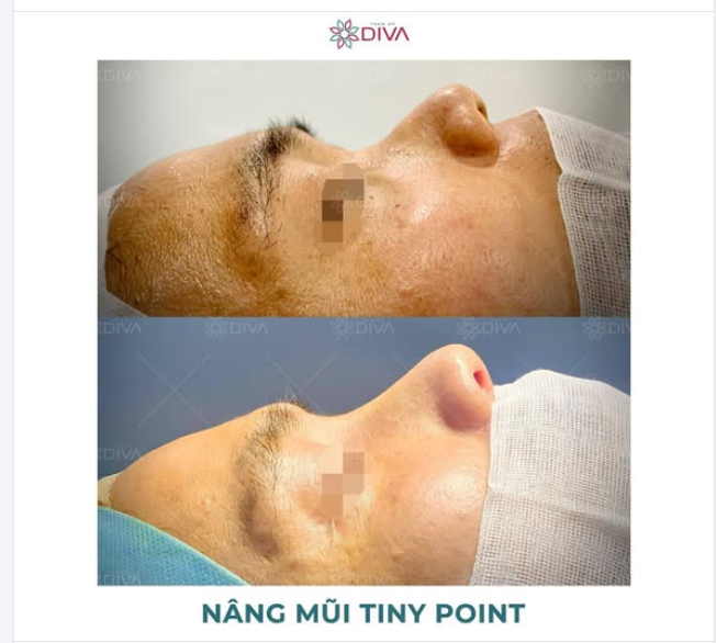 NÂNG MŨI TINY POINT - PHƯƠNG PHÁP LÀM ĐẸP VÙNG MŨI PHÙ HỢP VỚI NAM GIỚI