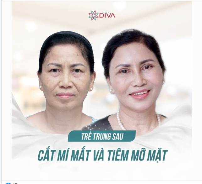 TRẺ TRUNG SAU CẮT MÍ MẮT VÀ CẤY MỠ MẶT