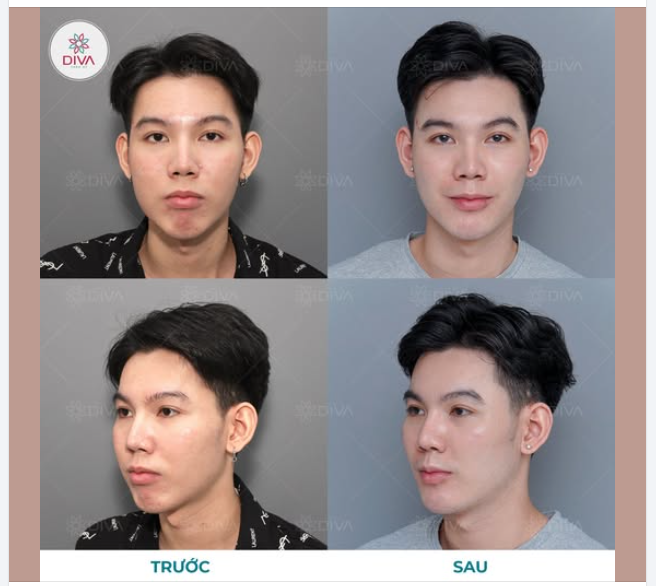 MẶT CHẢY XỆ, MÁ PHÍNH DO TÚI MỠ MÁ, CẰM LẸM THIẾU ĐỘ NHÔ VÀ KẾT QUẢ SAU THẨM MỸ?