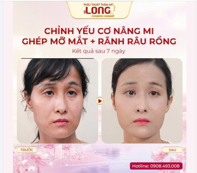 Cải thiện rãnh râu rồng và mí yếu cơ bẩm sinh tại PTTM Bác sĩ Long