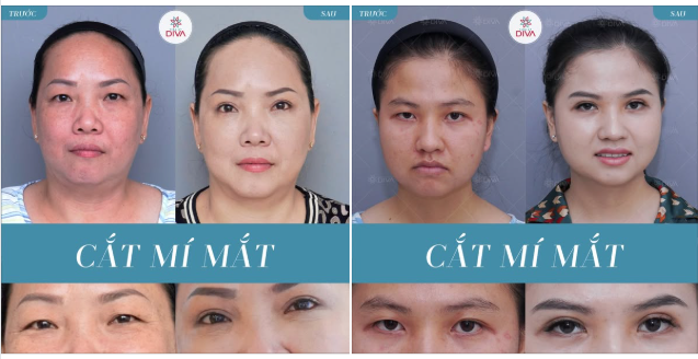 CẮT MÍ TẠI DIVA - ĐẸP TỰ NHIÊN SAU 7 NGÀY