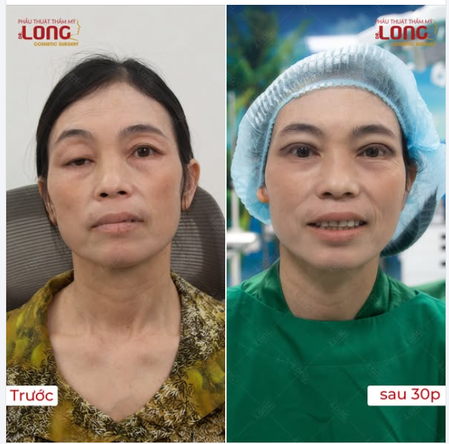 ƯỚC MƠ SAU 48 NĂM THÀNH HIỆN THỰC  30 PHÚT - SỞ HỮU ĐÔI MẮT MỚI