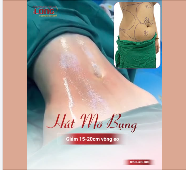 HÚT MỠ BỤNG - ĐÓN EO THON