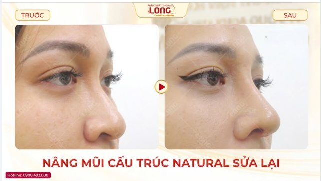 LÀM MŨI - ĐỪNG CHẠY THEO TREND