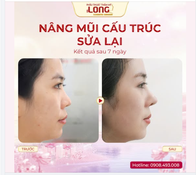 “ĐỔI MŨI” QUYẾT ĐỊNH SAI LẦM HAY ĐÚNG ĐẮN