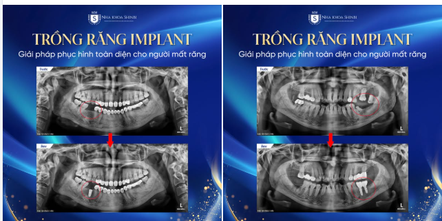 TẠM BIỆT NỖI LO MẤT RĂNG - CHÀO ĐÓN NỤ CƯỜI RẠNG RỠ