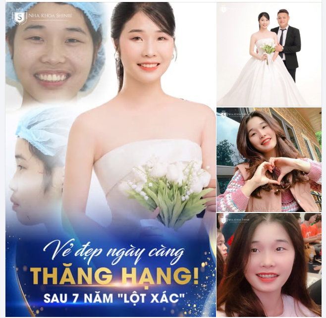 TỪ NIỀNG RĂNG TẠI SHINBI ĐẾN NỤ CƯỜI CÔ DÂU TOẢ SÁNG