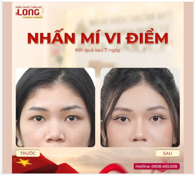 TÔI LÀ NẠN NHÂN CỦA PTTM  Cụ thể là nhấn mí…hối hận không kịp sau khi làm  Xin đừng phạm phải sai lầm như tôi.