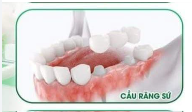 VIỆC BỌC SỨ SAU KHI LẤY TUỶ LÀ RẤT CẦN THIẾT VÌ