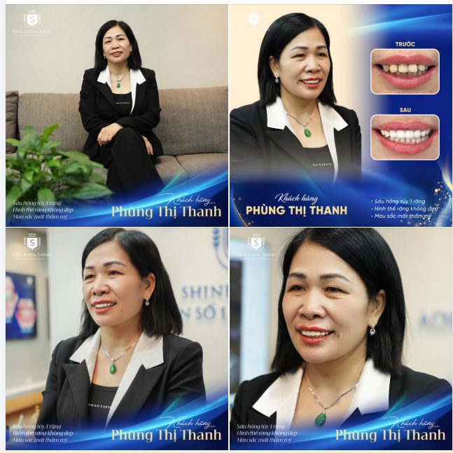 U50 THAY ĐỔI ẤN TƯỢNG VỚI RĂNG SỨ SHINBI