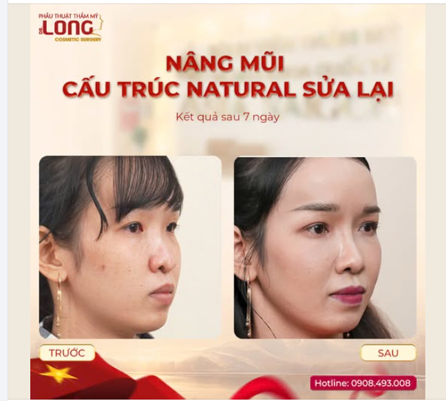 MŨI HỎNG KHÔNG PHẢI LÀ DẤU CHẤM HẾT…