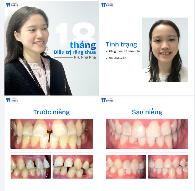 18 THÁNG ĐIỀU TRỊ RĂNG THƯA - HÔ CHÌA