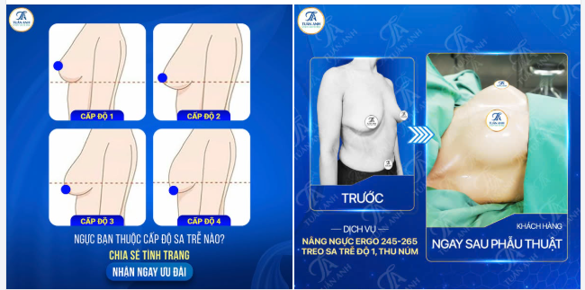 Treo sa trễ - Khôi phục nét thanh xuân vòng 1!