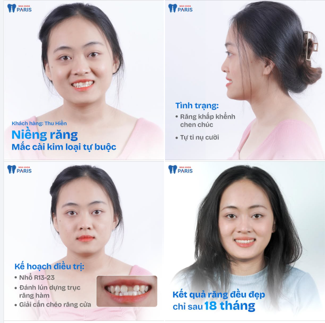 CHÚC MỪNG THÁO NIỀNG!  Giải khớp cắn chéo cho KH đến từ TP. HCM  BS Điều trị: Hồ Hiệp Anh Tuấn