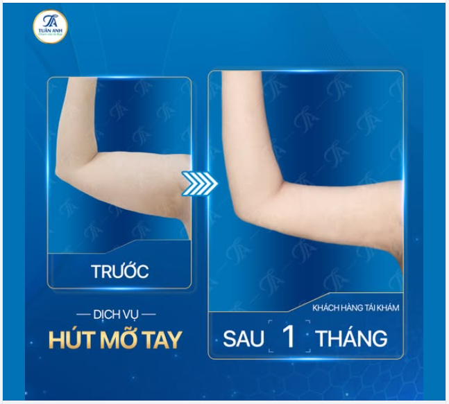 Giờ đây, mình tự tin khoe tay thon trong mọi outfit – đúng là thay đổi nhỏ nhưng khác biệt lớn!" – Chia sẻ từ khách hàng sau 1 tháng thực hiện dịch vụ Hút mỡ cánh tay