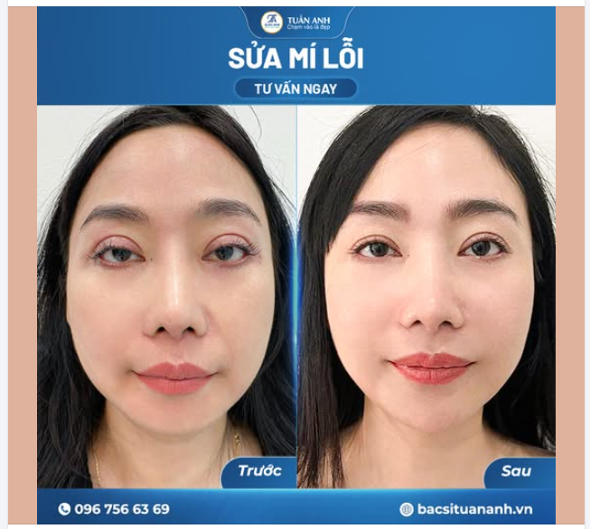 SỬA MÍ MẮT – LẤY LẠI NÉT ĐẸP TƯƠI TRẺ, TỰ NHIÊN!