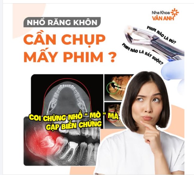 Nhổ răng khôn cần chụp mấy phim?