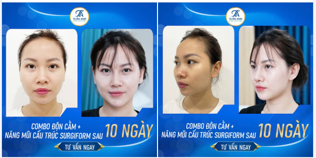 Nâng mũi Sugiform kết hợp độn cằm Vline – Bước ngoặt nhan sắc chỉ sau 10ngày!