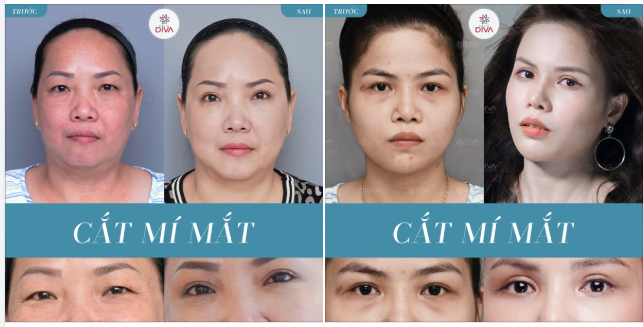 CẮT MÍ MẮT: MẮT ĐẸP, 2 MÍ ĐỀU SAU 7 NGÀY