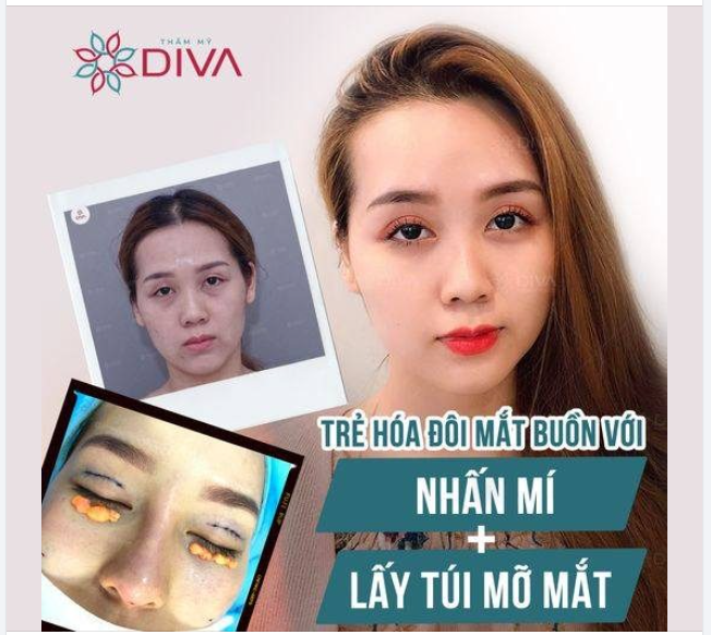 LOẠI BỎ TÚI MỠ LÀM MẮT NẶNG NỀ, "CỨU VÃN" ĐƯỢC CẢ THẦN THÁI KHUÔN MẶT?
