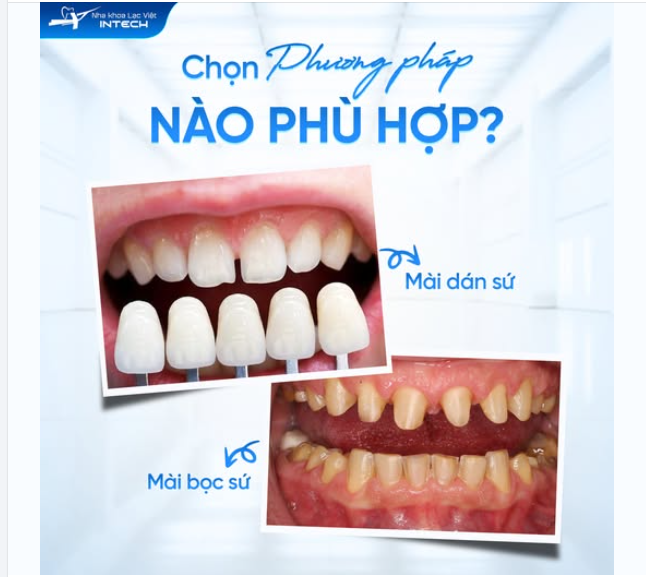 DÁN SỨ VENEER VÀ BỌC SỨ - CHỌN PHƯƠNG PHÁP NÀO PHÙ HỢP?
