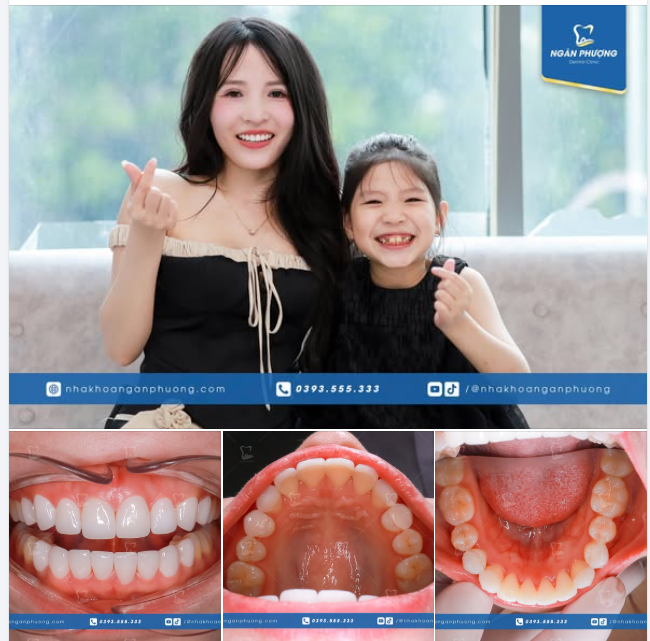 Miếng dán sứ siêu mỏng, siêu đẹp thiết kế riêng dành cho chị Trang