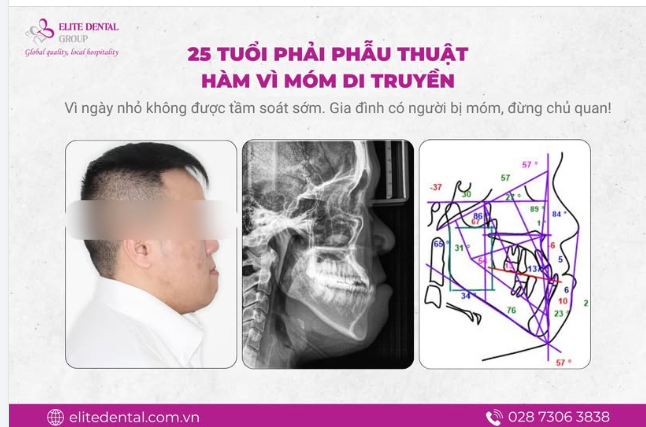 MÓM DI TRUYỀN - 25 TUỔI ĐI PHẪU THUẬT HÀM CHỈ VÌ BỎ LỠ THỜI ĐIỂM VÀNG KHI CÒN NHỎ