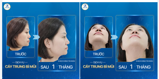 Tạo hình lại đầu mũi đẹp, thon gọn, cân đối với sống mũi tạo dáng mũi hài hòa hoàn chỉnh !