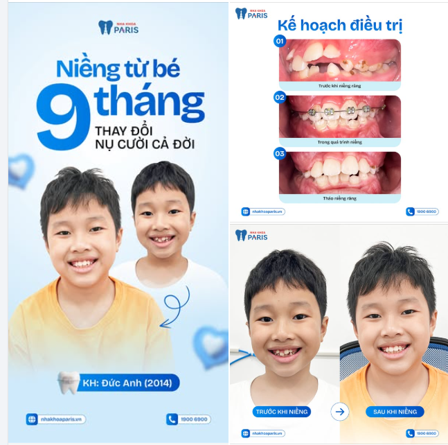 NIỀNG RĂNG ĐỘ TUỔI VÀNG  CON TỰ TIN - BỐ MẸ TỰ HÀO!