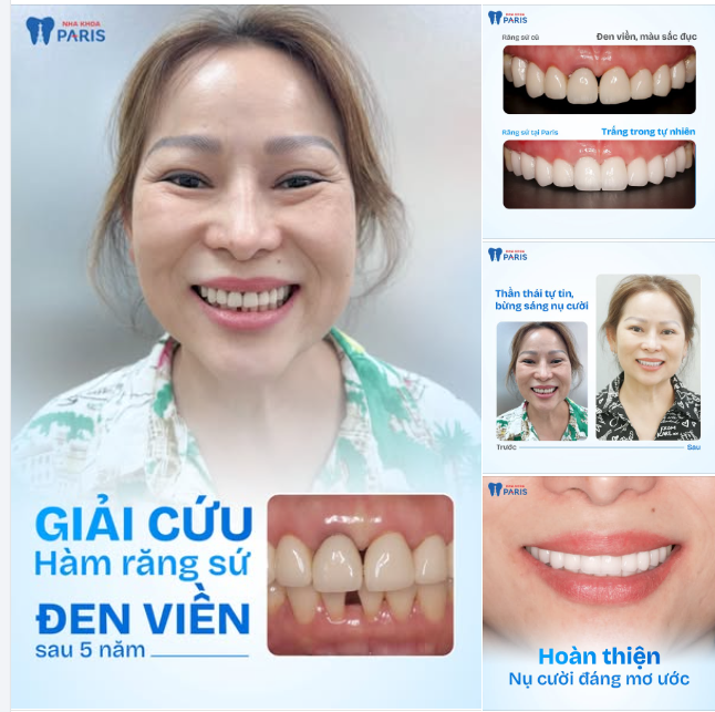 5 NĂM SỐNG VỚI HÀM RĂNG SỨ ĐEN VIỀN – CÔ HẰNG CUỐI CÙNG ĐÃ CƯỜI RẠNG RỠ TRỞ LẠI!