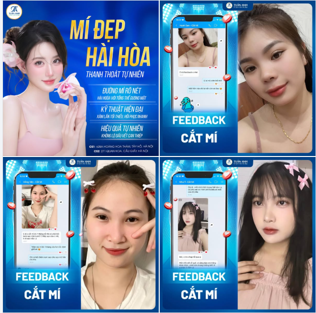 Một đôi mắt 2 mí đẹp hài hòa luôn là mong muốn của tất cả các chị em có tình trạng mí lót, mí sụp, da dư nhiều.