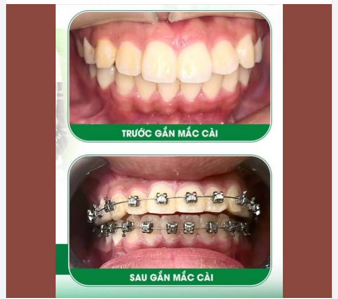 NIỀNG RĂNG - BÍ QUYẾT CẢI THIỆN RĂNG HÔ