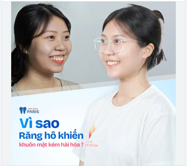 VÌ SAO RĂNG HÔ KHIẾN KHUÔN MẶT KÉM HÀI HOÀ?