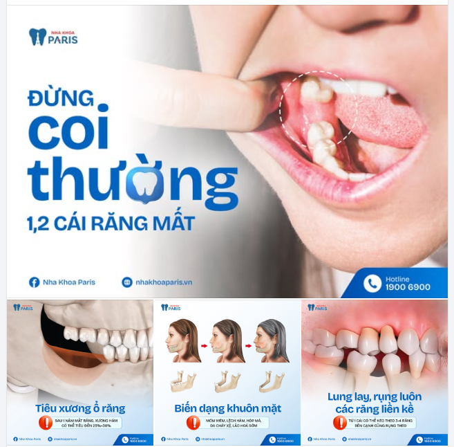 Mất 1,2 cái răng Hãy đọc bài này trước khi quá muộn  "Còn nhiều răng mà, tội gì phải tốn tiền trồng lại"