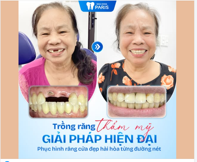 Giải pháp hiện đại – Phục hình răng hài hòa từng đường nét