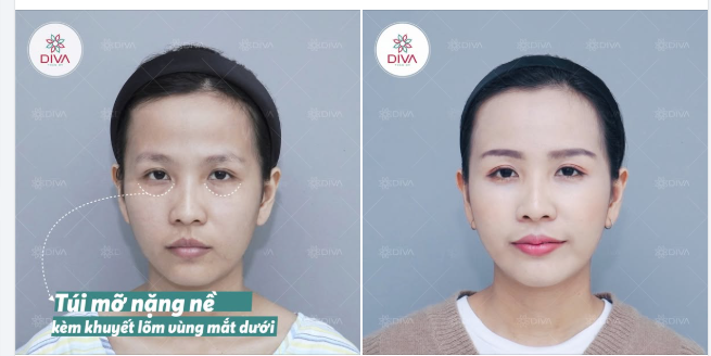 MẮT DƯỚI BỊ BỌNG M.Ỡ VÀ KHUYẾT LÕM – NHÌN GIÀ HƠN 5 TUỔI LÚC NÀO KHÔNG HAY!