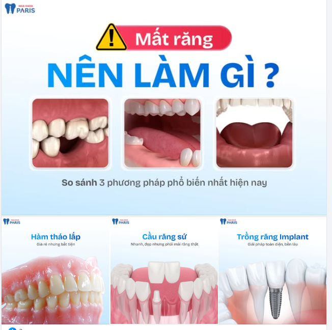 MẤT RĂNG – NÊN LÀM GÌ?
