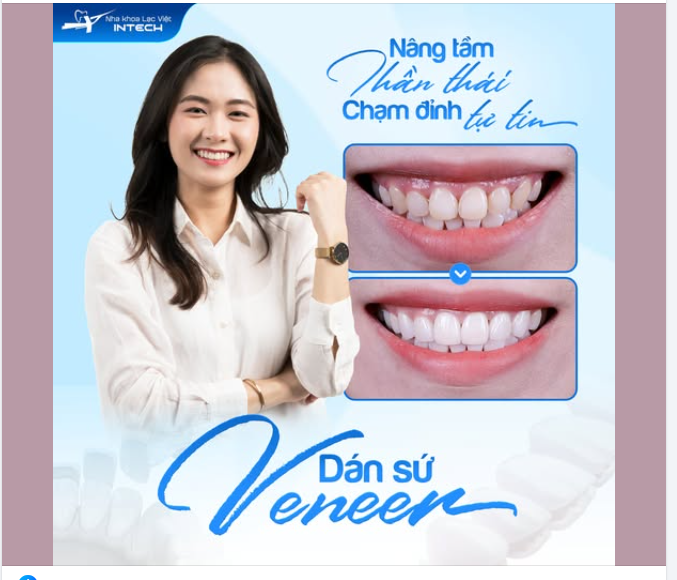 NỤ CƯỜI NÂNG TẦM THẦN THÁI - CHẠM ĐỈNH TỰ TIN NHỜ DÁN SỨ VENEER
