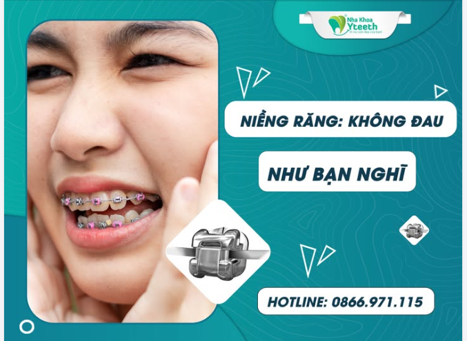 NIỀNG RĂNG - KHÔNG ĐAU NHƯ BẠN NGHĨ