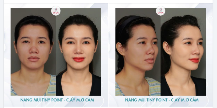 BIẾN HÓA TRỞ NÊN TƯƠI TẮN & TỰ TIN HƠN NHỜ COMBO LÀM ĐẸP CẤY MỠ CẰM - NÂNG MŨI TINY POINT!