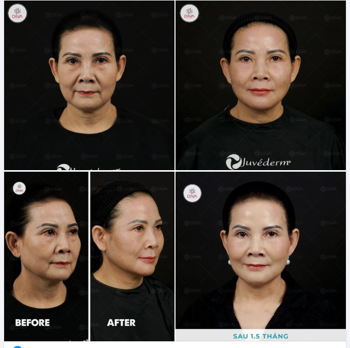 U60 SAU KHI TIÊM 16CC FILLER MD CODES THÌ KẾT QUẢ SẼ NHƯ THẾ NÀO?